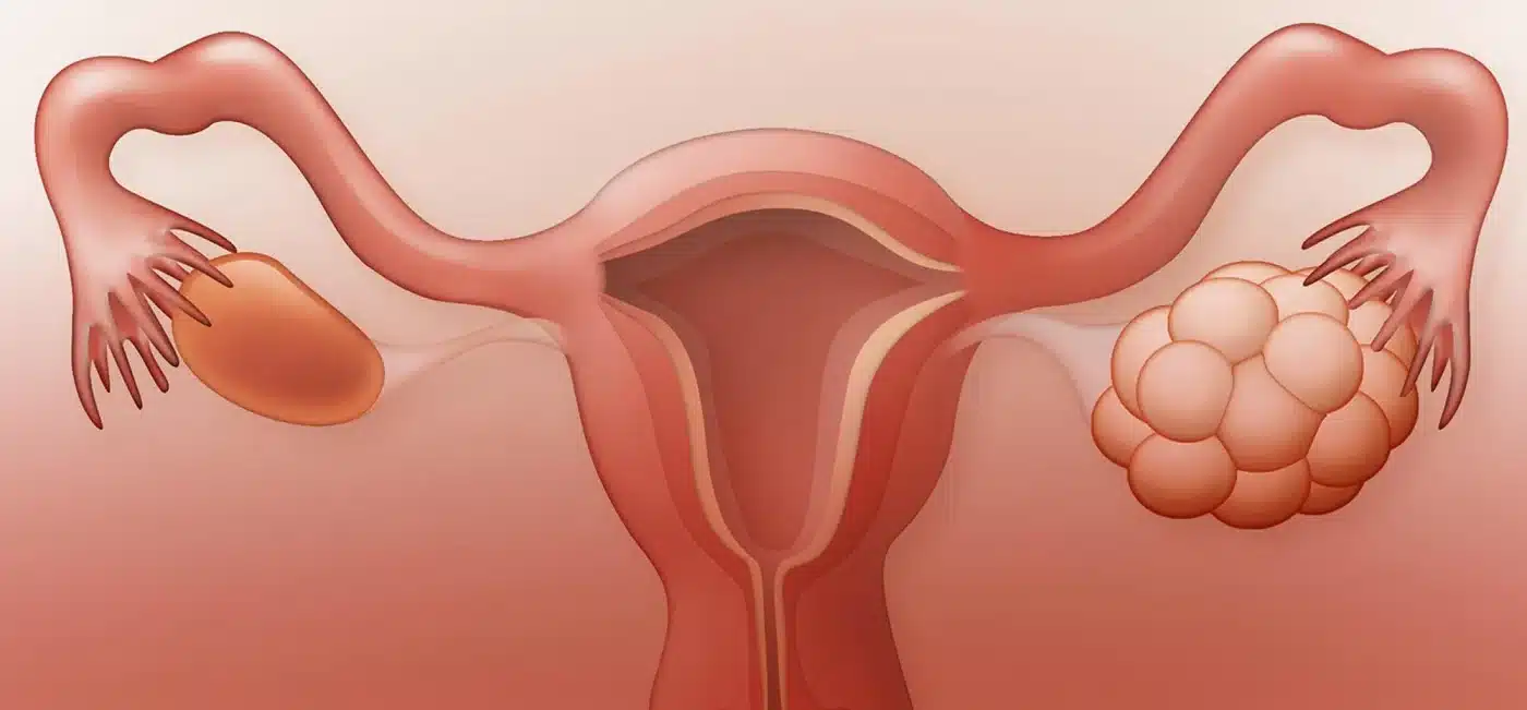 Polycystic Ovary Syndrome – PCOSسندروم تخمدان پلی‌کیستیک چیست؟