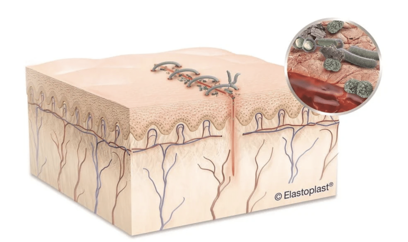 زخم جراحی یا زخم پس از عمل 